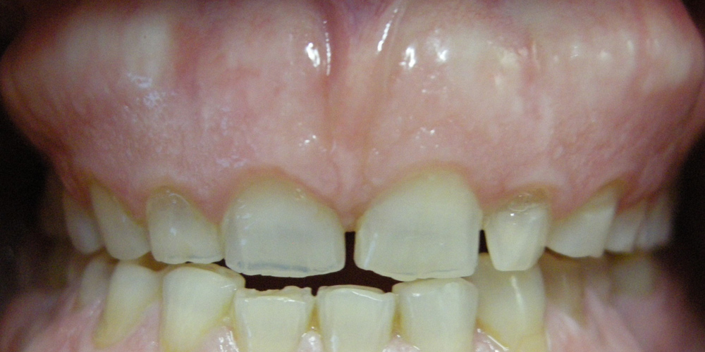 Hipersensibilidad en los dientes