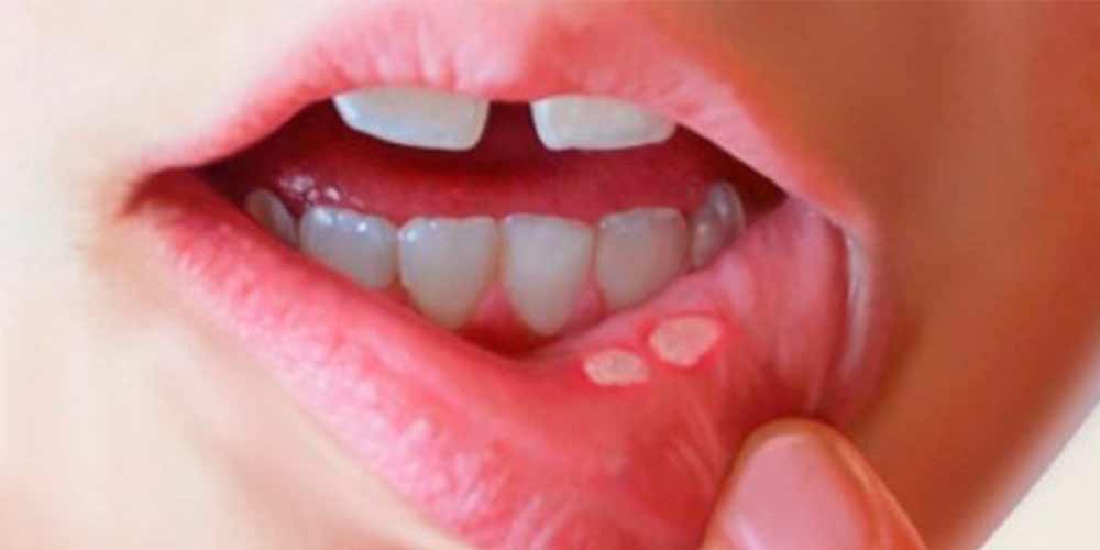 tratar las aftas bucales Badía Clínica Dental