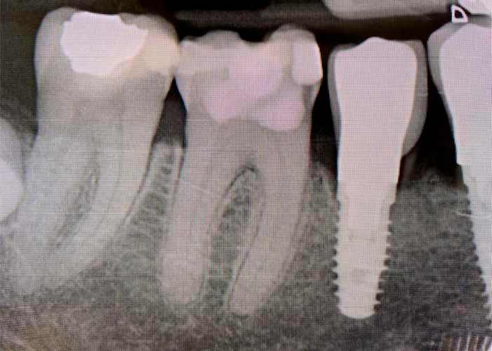 Implante dental en Valencia