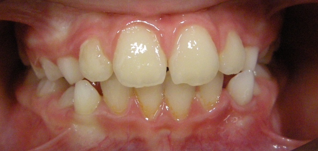 ortodoncia temprana o interceptiva
